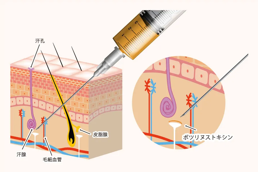 ワキ汗ボトックス治療イメージ